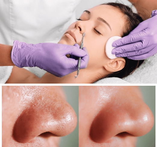 Clogged-Pores